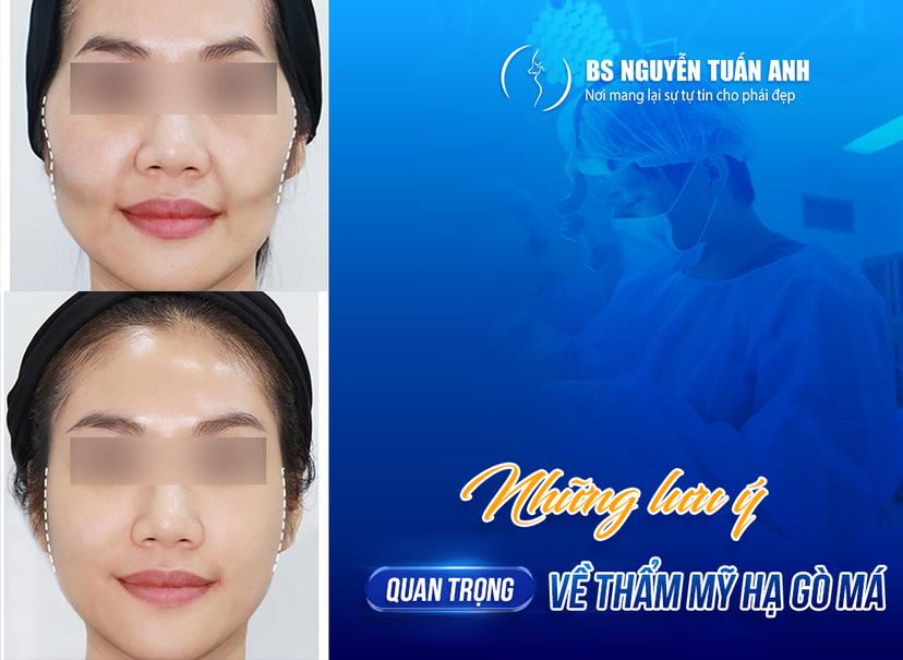 Hạ gò má